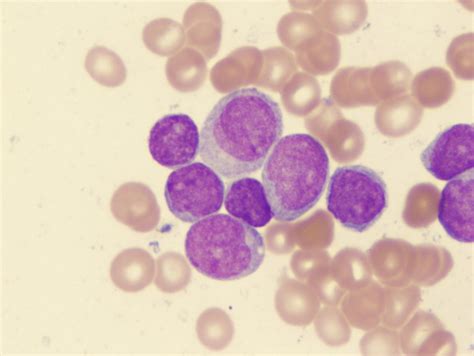 Acute myelogenous leukemia cells. Credit: Univ. of Virginia