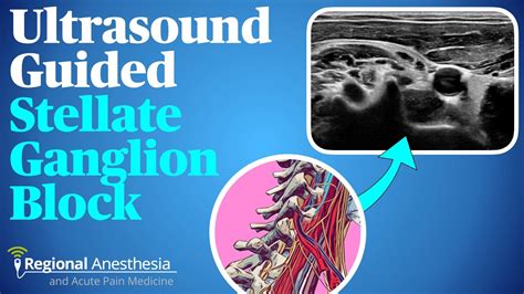 Ultrasound guided stellate ganglion block - YouTube