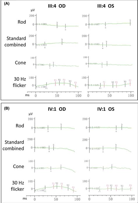 Electroretinography results for patients III:4 and IV:1 Non-recordable ...