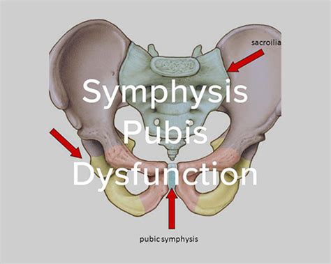 Pubic Symphysis Dysfunction - JK Physio and Rehab Clinics