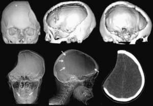 Decompressive-hemicraniectomy | Vikram Udani, MD