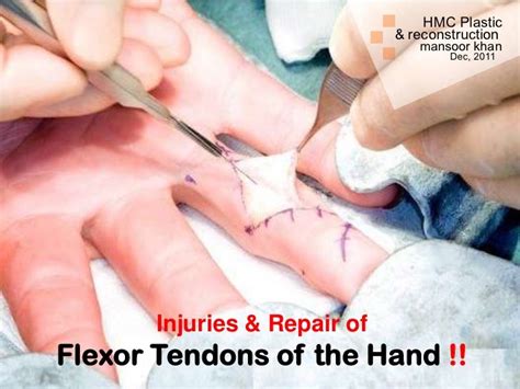 Flexor tendon injuries.m