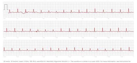 inappropriate sinus tachycardia, does this look like anything else? : r ...