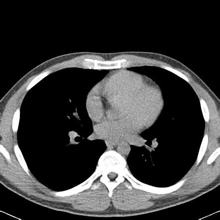 Lung Ct Scan Without Contrast