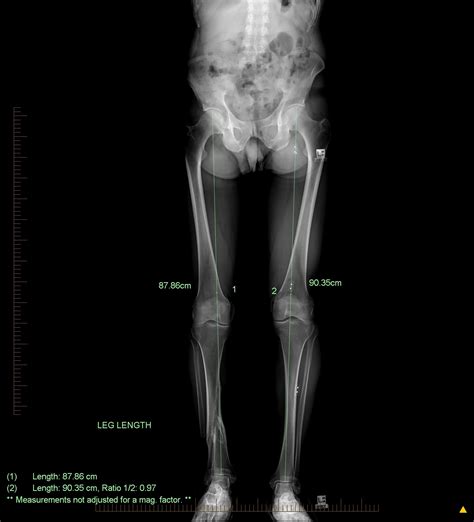 Leg Length Scans – Riverside Medical Imaging