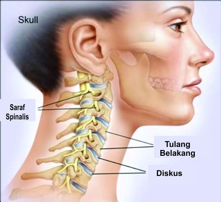 Terapi Saraf Kejepit pada Leher Tanpa Operasi dengan Decompression Traction System (DTS)