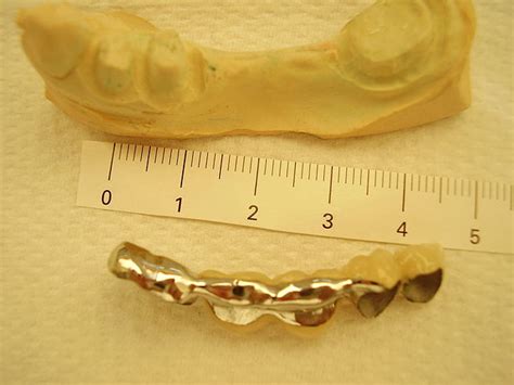 Significance of Gold Dental Bridges | Staying Healthy