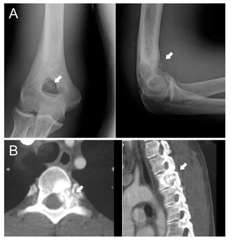 JCM | Free Full-Text | Osteoblastoma: When the Treatment Is Not ...