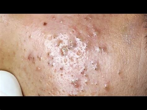 Relax every day wit spa #312 Popping huge blackheads and Pimple Popping - Best Pimple Popping ...