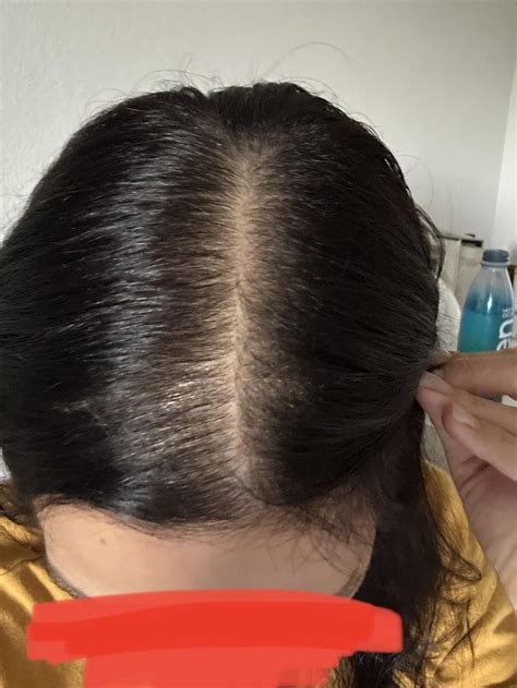 Improvement after losing all my spironolactone hair growth. : r ...