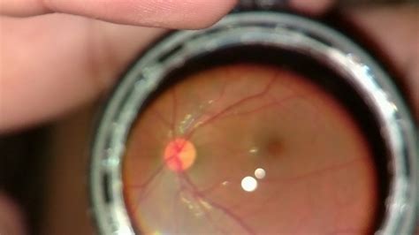 Open Indirect Ophthalmoscope — L V Prasad Eye Innovations