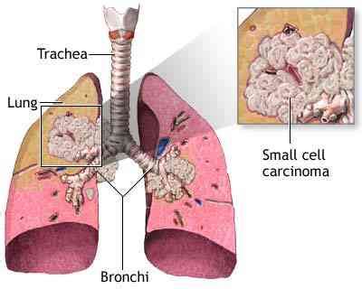 Small Cell Cancer of the Lung