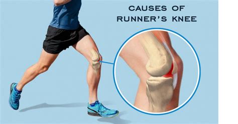 Runner’s Knee Causes, Symptoms, Precautions and Therapy Programs