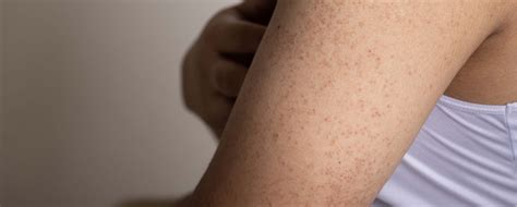 Keratosis pilaris treatment: What are the options?