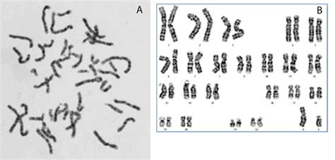 Metaphase image and Karyotyping image. (A) The metaphase image with... | Download Scientific Diagram