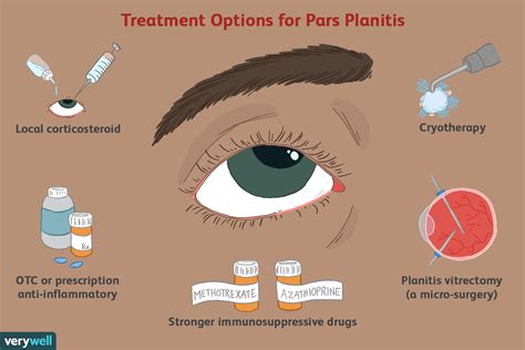 Pars Planitis: Symptoms, Causes, Diagnosis, Treatments