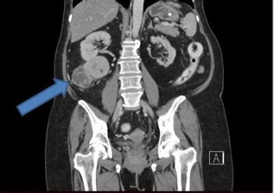 Kidney Tumor CT Scan [IMAGE] | EurekAlert! Science News Releases