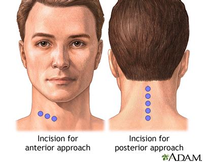 Anterior Cervical Discectomy & Fusion (ACDF) | Antonio Webb - Neck, Back, and Spine Specialist