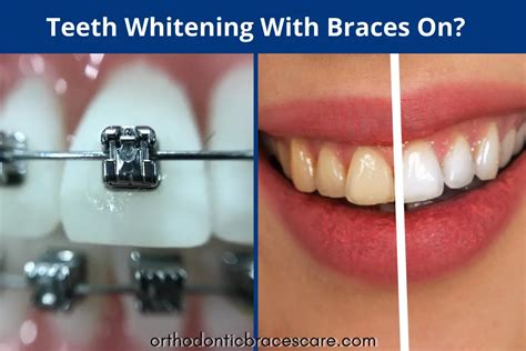 Can You Whiten Your Teeth With Braces On? - Orthodontic Braces Care