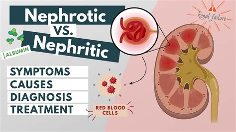 Nephrotic vs. Nephritic syndrome | Symptoms, diagnosis, causes, treatment | Visual explanation ...