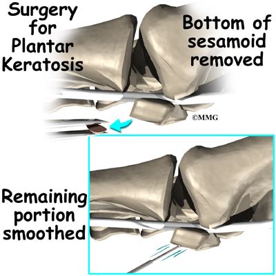 Sesamoid | eOrthopod.com