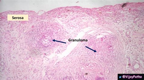 Intestinal Tuberculosis - Pathology Made Simple