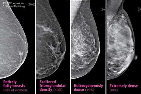 Breast cancer density laws mean more tests, unclear benefit - Philly