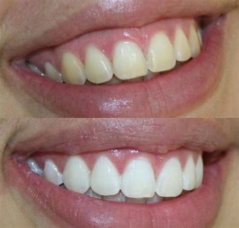 Pola Light Advanced Teeth Whitening System - Todays Dental