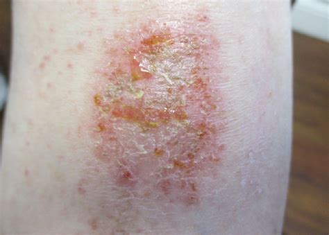 What Is Causing These Oozing, Crusting Plaques on a Man’s Shins ...