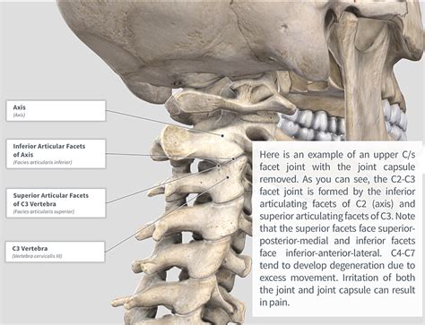 Cervical Facet Syndrome/Spondylosis — PhysioU