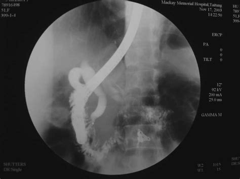 Endoscopic retrograde cholangiography with injection of contrast agent... | Download Scientific ...