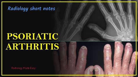 Psoriatic Arthritis X Ray