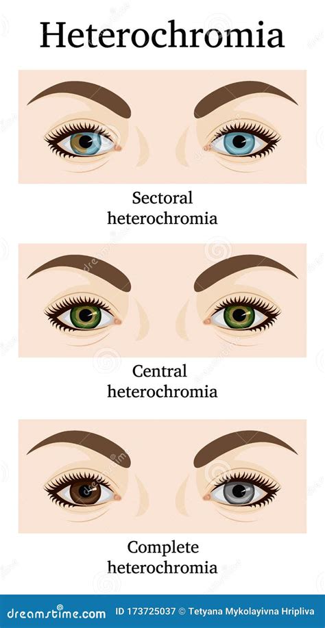 Illustration of Heterochromia Iridum Stock Vector - Illustration of medical, complete: 173725037