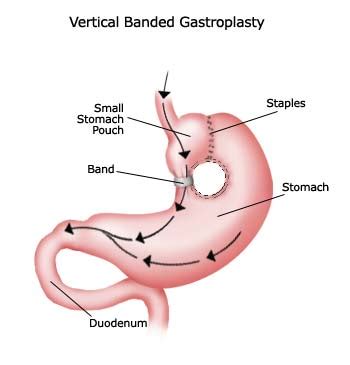 Ask the Doctor: Bariatric Procedures Explained