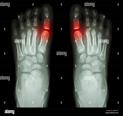 "Rheumatoid arthritis , Gouty arthritis" X-ray child's foots and arthritis at ...