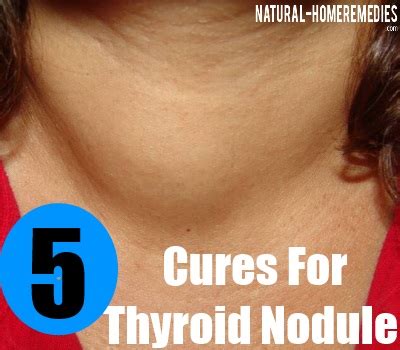 5 Natural Cure For Thyroid Nodules - Natural Treatment For Thyroid Nodules | Natural Home ...