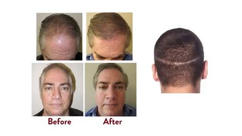 Top Hair Transplant Techniques Today - YouTube