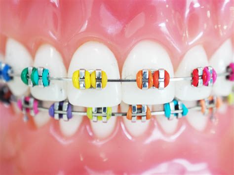 Braces Colors - Coloring