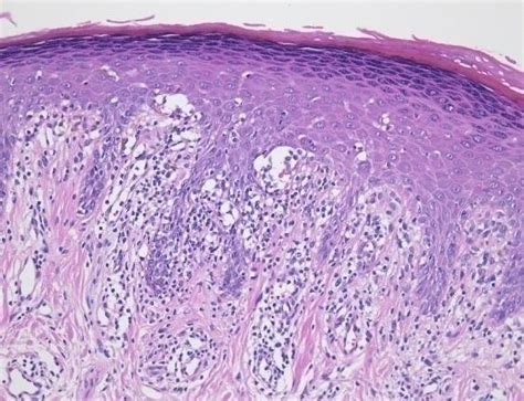 Oral Lichen Planus with saw-toothed rete ridges and band like... | Download Scientific Diagram