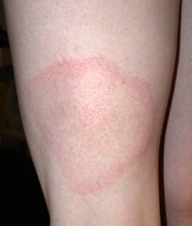 Rashes | Lyme Disease Action