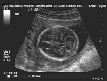 The Normal Cerebellum