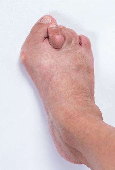 How long is the recovery time for bunion surgery? | Podiatry Associates ...