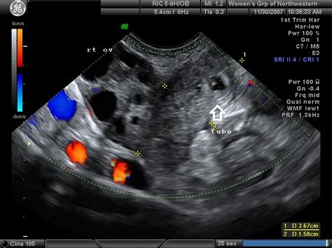 Diagnostic Ultrasound in the First Trimester of Pregnancy | GLOWM