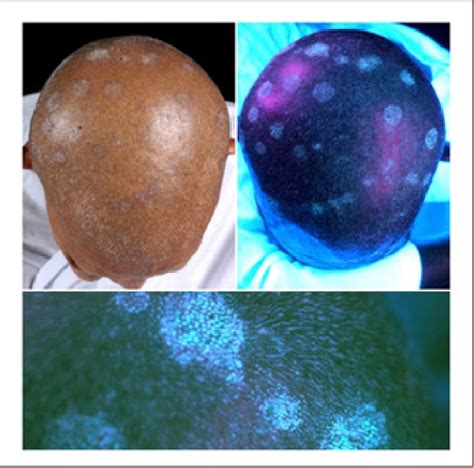 Figure 1 from Wood's Lamp Examination: Evaluation of Basic Knowledge in General Physicians ...