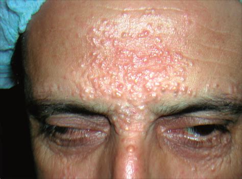 Multiple Apocrine Hidrocystoma of the Face Treated With a 1450-nm Diode Laser | Dermatology ...