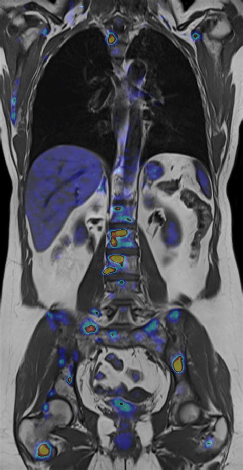 How does a PET scanner work? - www.medicalradiationinfo.org