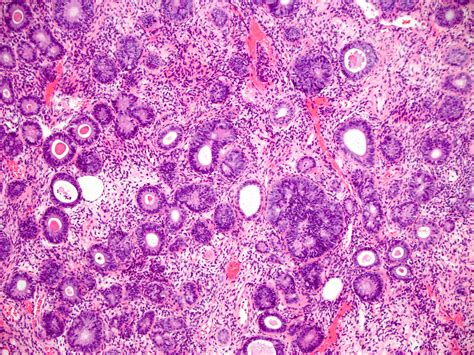 Endometrial Hyperplasia Histology