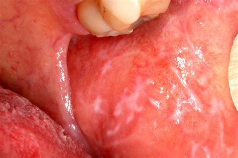 Lichen planus | Enhanced Dental CPD Online