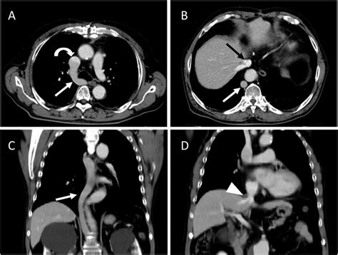 Preoperative contrast-enhanced computed tomography (CT). (A) CT ...