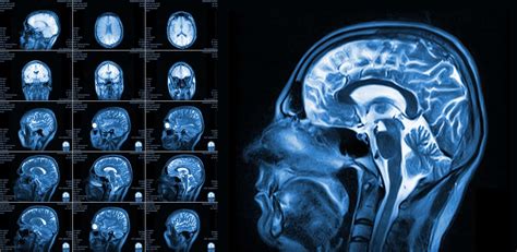 Imaging iron content with MRI technique can show impact of stroke ...